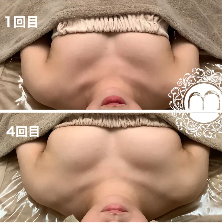 美乳再生の1回目と4回目の比較